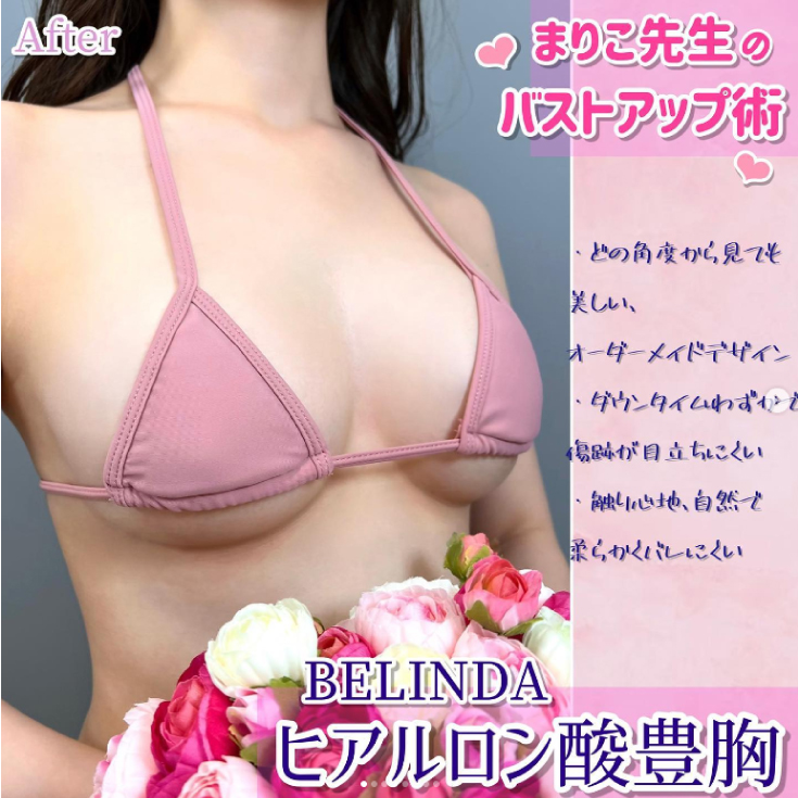 ヒアルロン酸豊胸症例