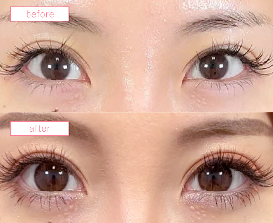 二重埋没法ビフォーアフターcase02