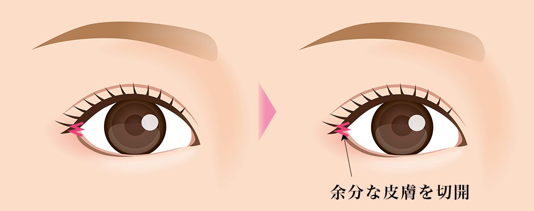 目尻切開_素材②