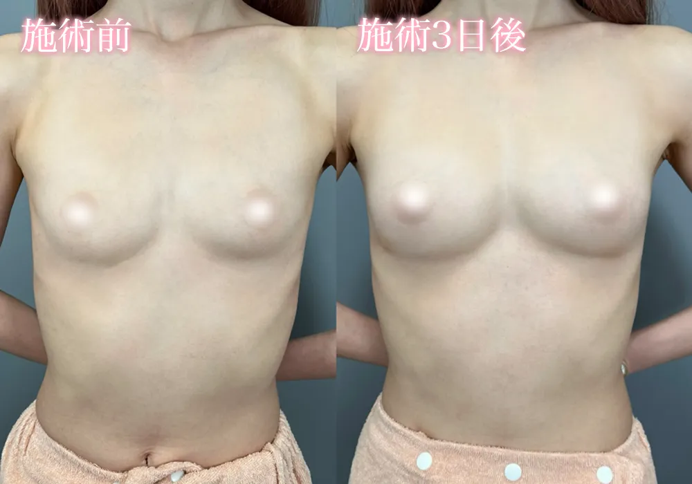 ヒアルロン酸豊胸症例
