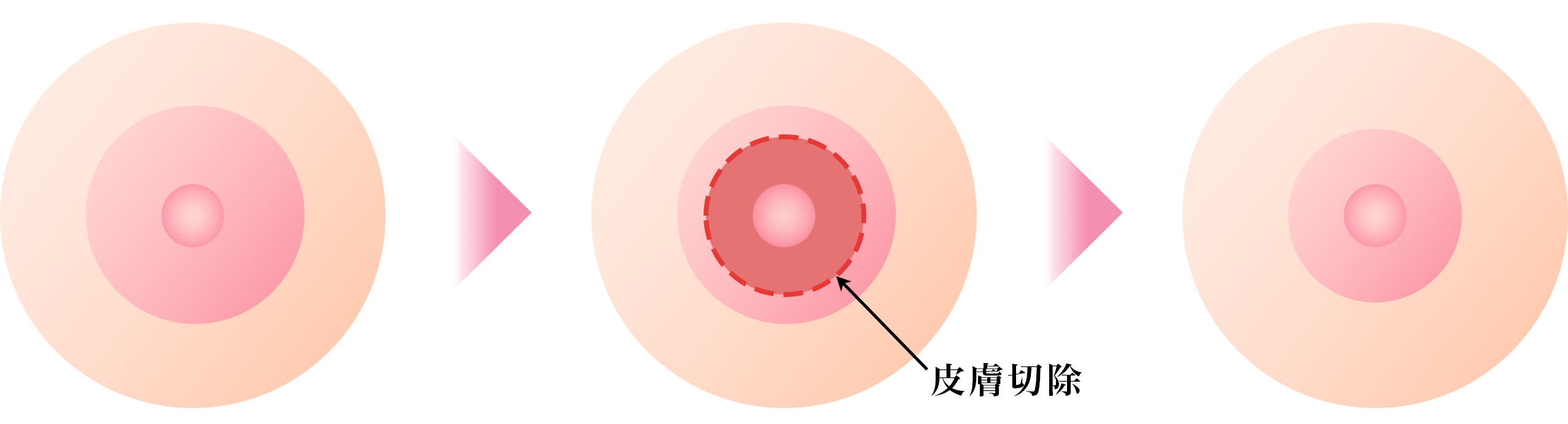 内側切除法(乳輪の内側)