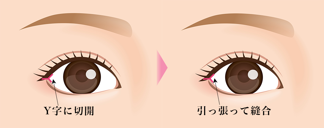 目尻切開_素材①