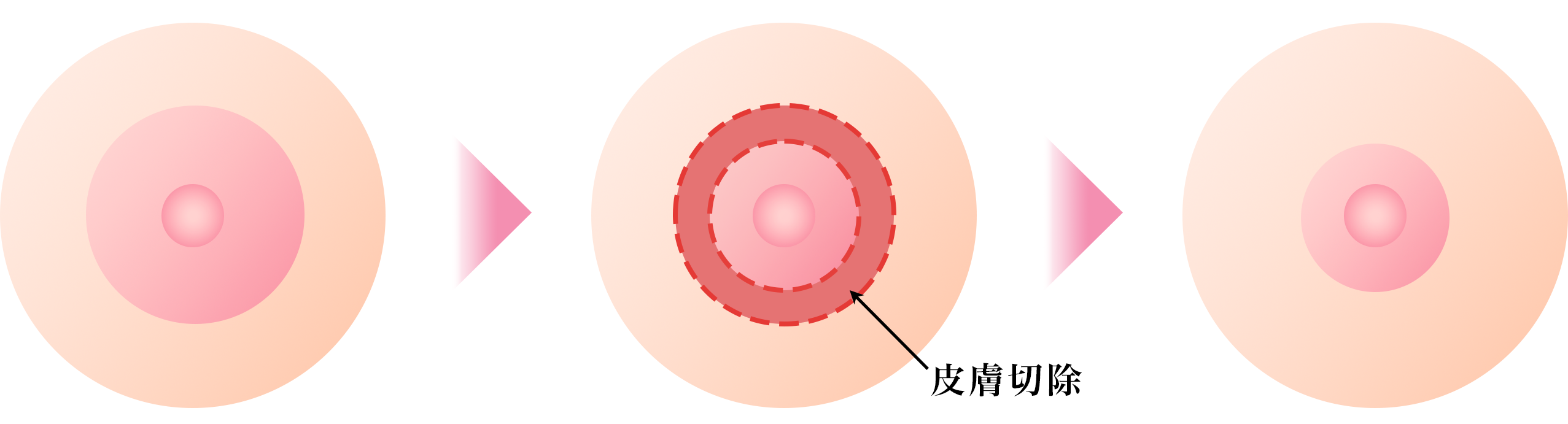 外側切除法(乳輪の外側)