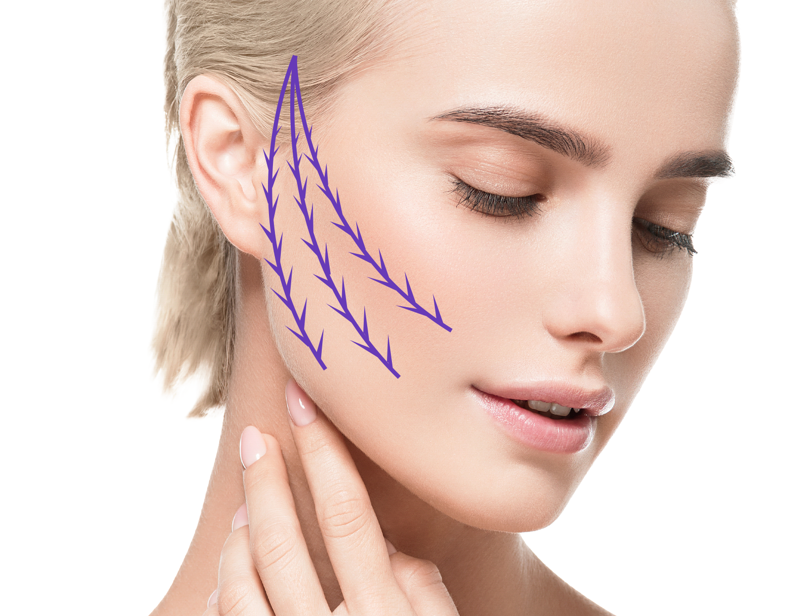 糸によるリフトアップ