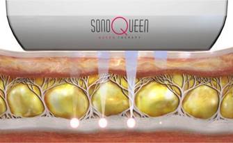 HIFU_素材②(ソノクイーン)