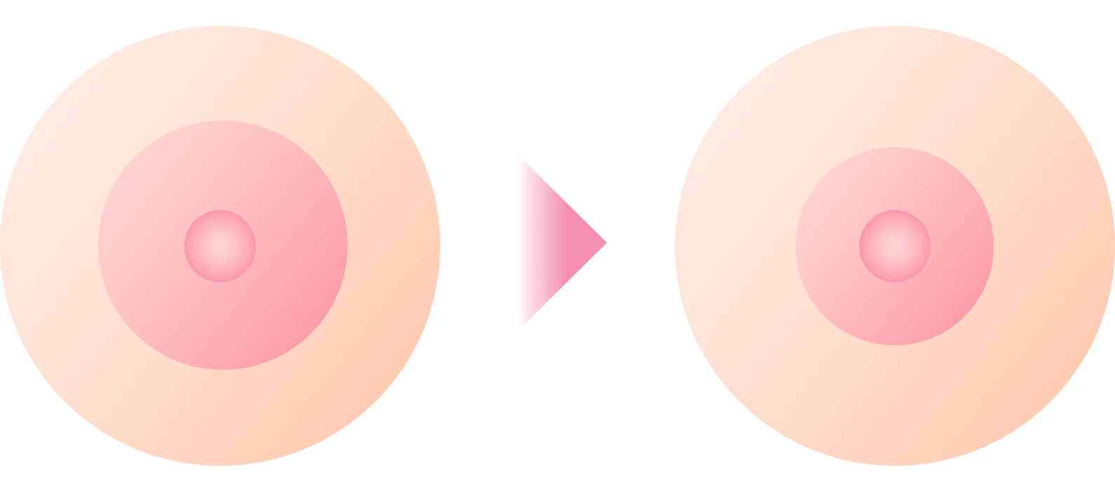 乳輪縮小術について