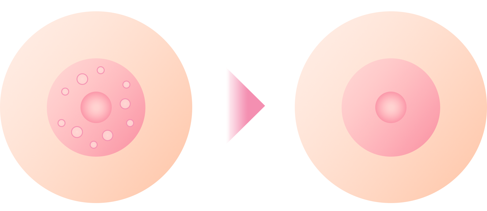 モントゴメリー線切除