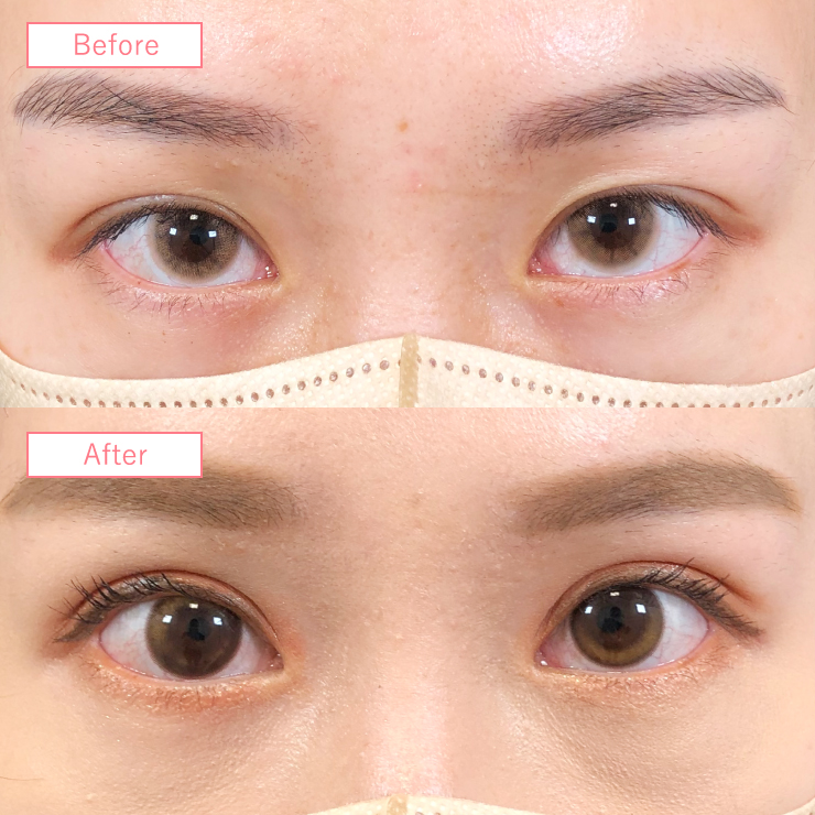 二重埋没法症例2662