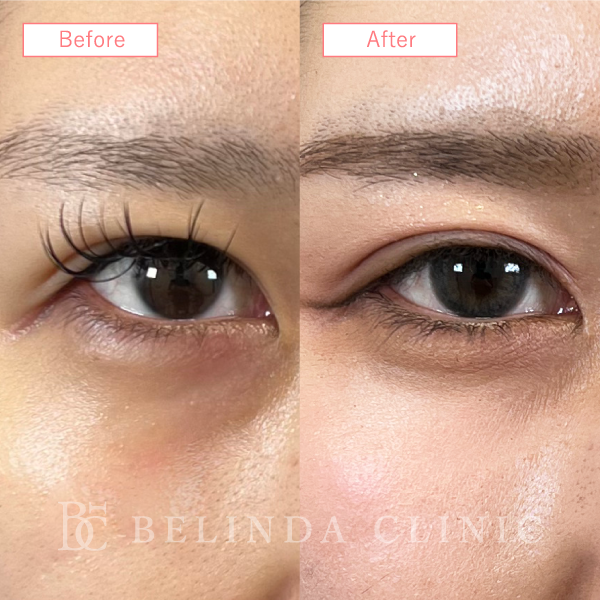 目上切開症例No3857