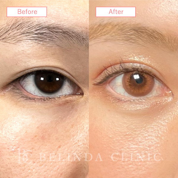 目上切開症例No4006