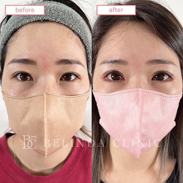 二重整形埋没法症例No288