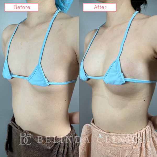 脂肪豊胸症例No373