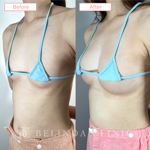 脂肪豊胸症例No421