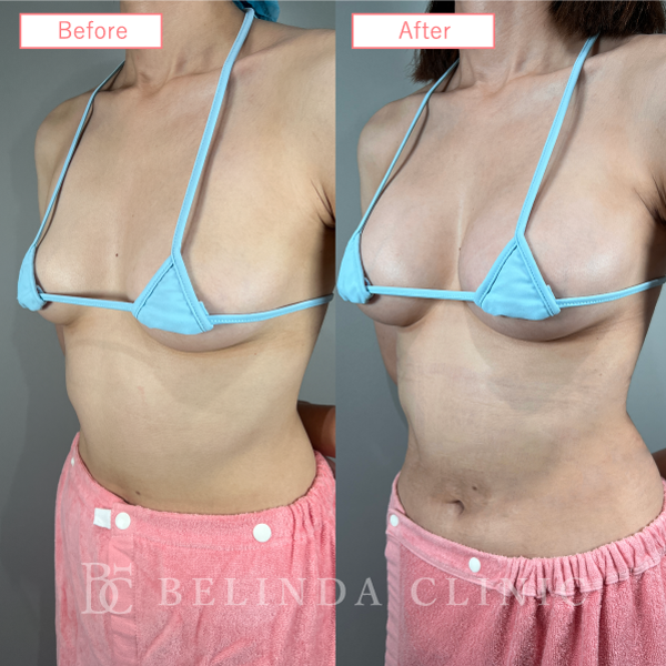 ハイブリッド豊胸症例No681