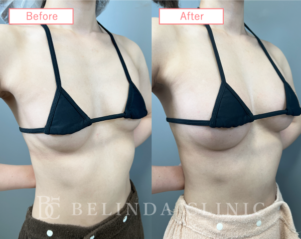 脂肪豊胸症例No2087_02