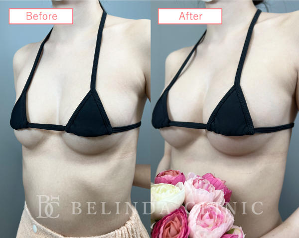 脂肪豊胸症例No2343