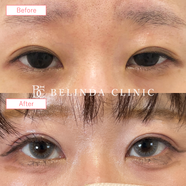 目上切開症例No2819