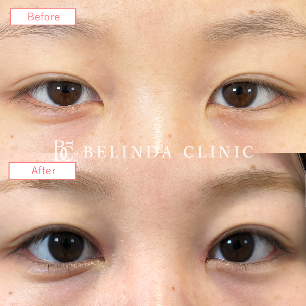 目上切開症例No5377