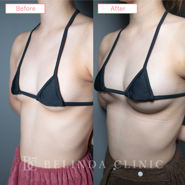 脂肪豊胸症例No6101