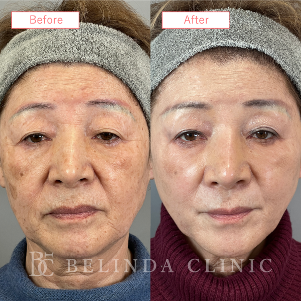 糸リフト症例No1836