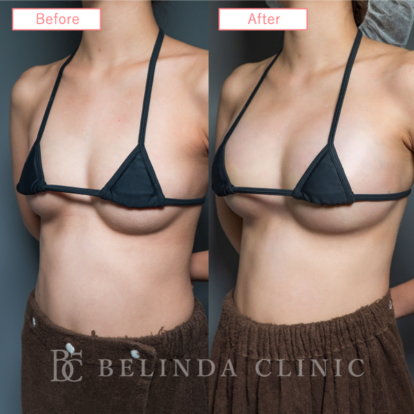 脂肪豊胸症例No7094