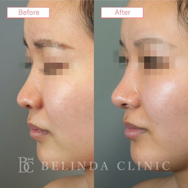 鼻中隔延長術症例No_staff02