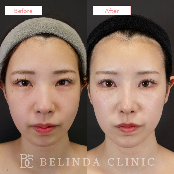 鼻尖形成・鼻プロテーゼ