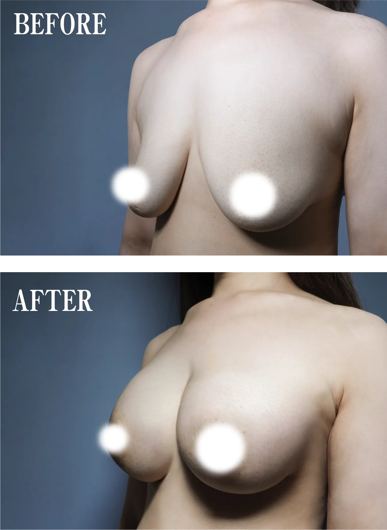 あなたの整形・ハイブリッド豊胸ビフォー・アフター01