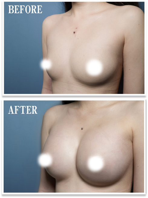 あなたの整形・ハイブリッド豊胸ビフォー・アフター02
