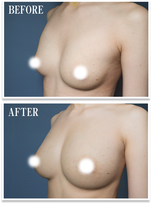 あなたの整形・脂肪注入豊胸ビフォー・アフター03