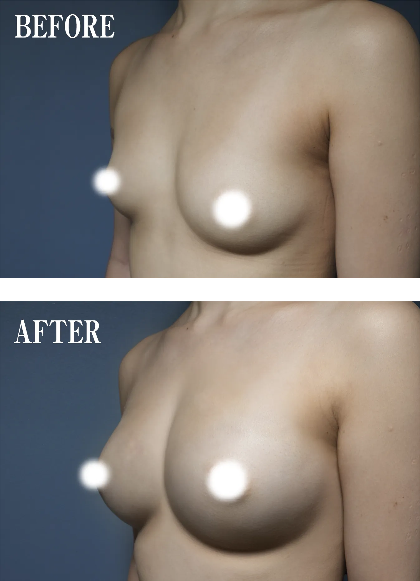 あなたの整形・脂肪注入豊胸ビフォー・アフター04