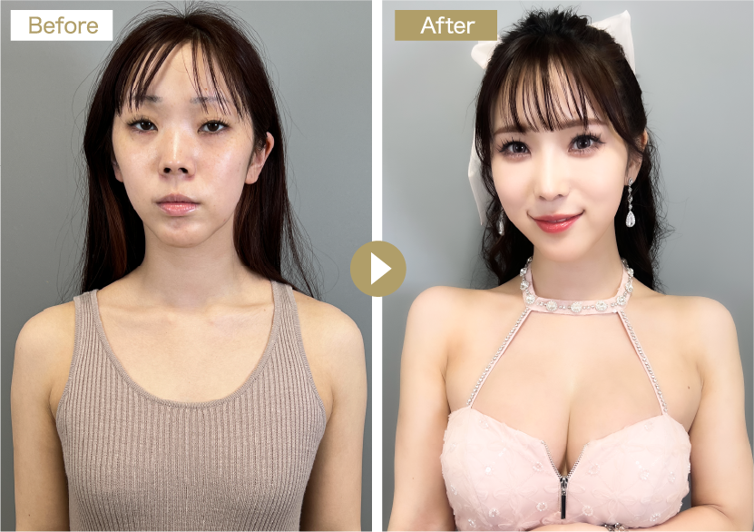 Rちゃん整形企画ビフォア・アフター