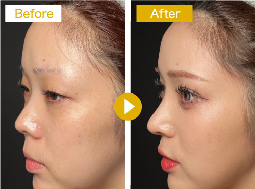 症例：鼻プロテーゼと鼻中隔延長