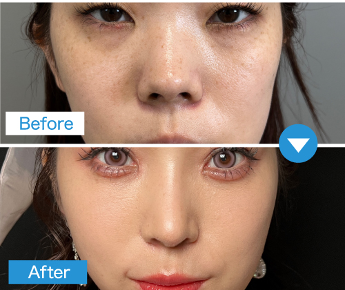 症例：裏ハムラ法とミッドフェイスリフト