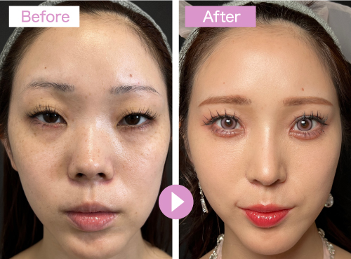 症例：糸リフトと顔の脂肪注入