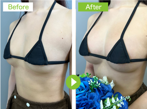 症例：脂肪注入豊胸