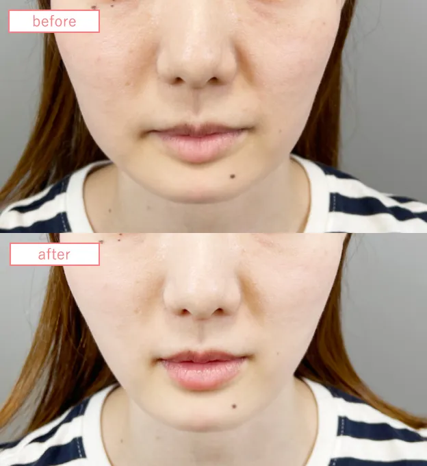 糸リフトビフォーアフターcase