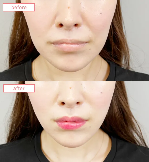 糸リフトビフォーアフターcase