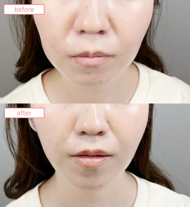 糸リフトビフォーアフターcase