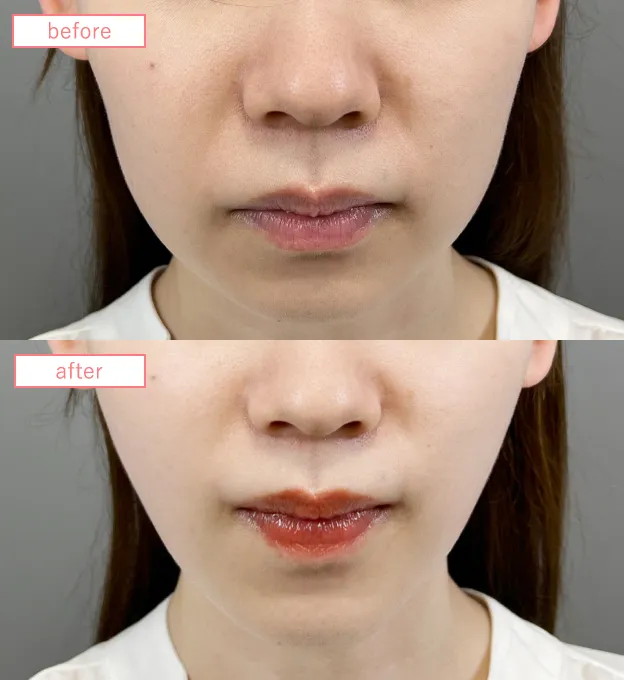 糸リフトビフォーアフターcase