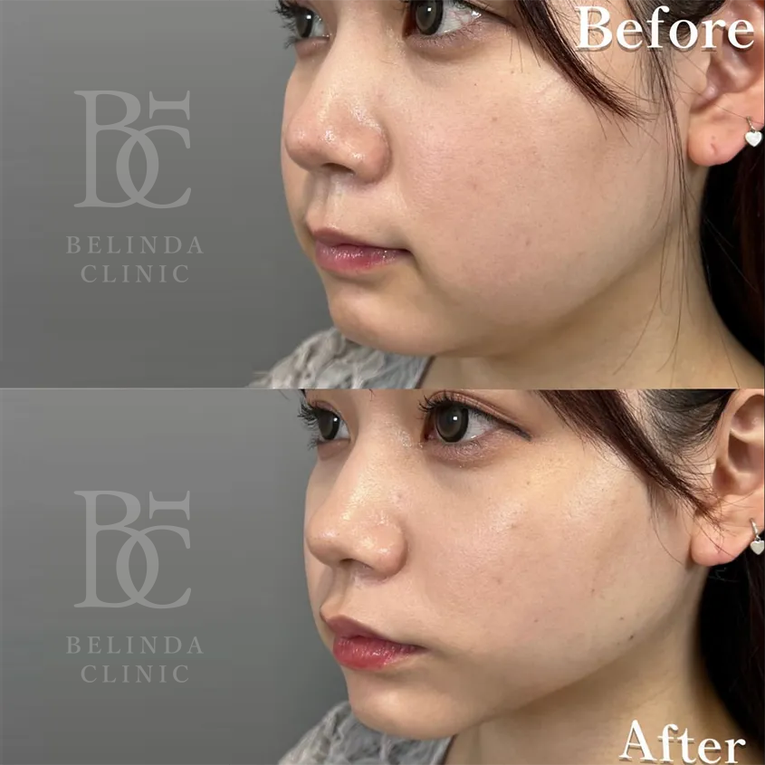 小顔脂肪吸引(顎・頬)case02