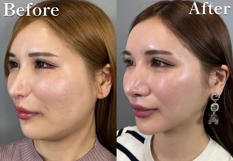 小顔脂肪吸引(顎下・エラ)case03