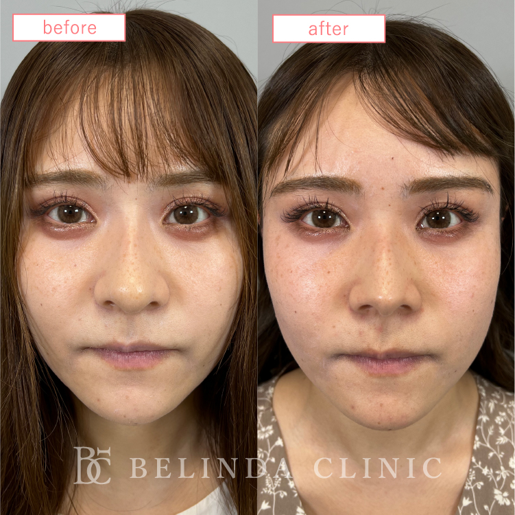 鼻尖形成ビフォーアフターcase05