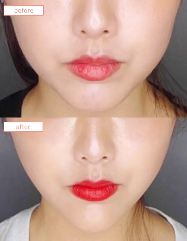 糸リフトビフォーアフターcase