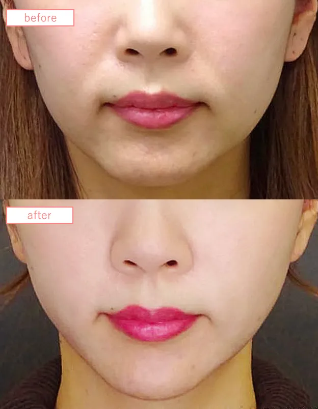 糸リフトビフォーアフターcase