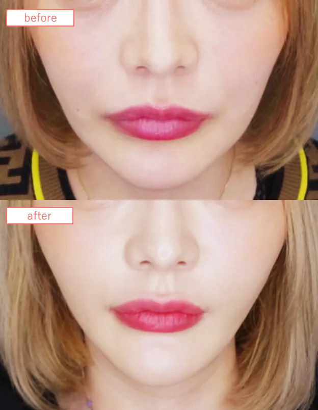 糸リフトビフォーアフターcase