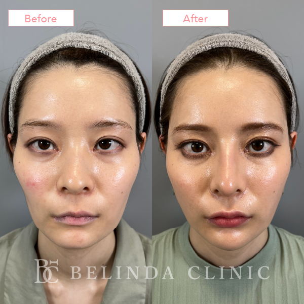 鼻尖縮小・鼻尖形成症例case10