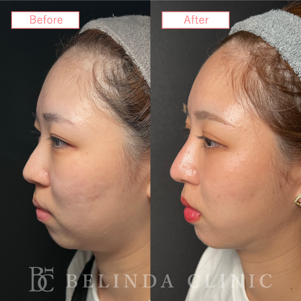 鼻プロテーゼ症例case01