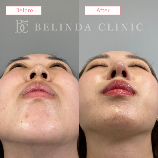 鼻尖縮小・鼻尖形成症例case04