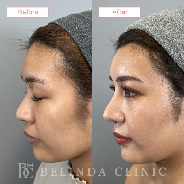 鼻プロテーゼ症例case02